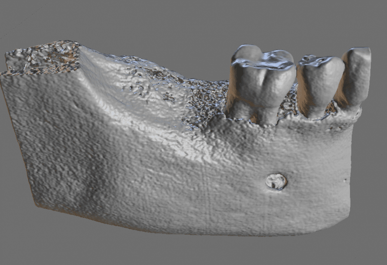 CBCT Scan