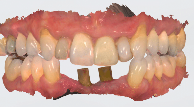 3D mouth scan