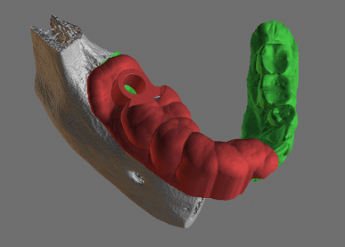 3D View of Implant Guide