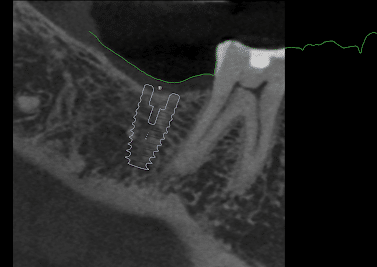 Cross sectional CBCT view