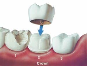 Crown process: 1. Tooth is Broken and requires repair. 2. Tooth is prepared for crown by carefully reducing tooth structure from circumference and top of tooth. 3. Crown is manufactured and cemented over tooth, restoring strenght to the tooth