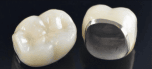 picture of porcellain fused to metal crown with occlusal surface visiable and internal fitting surface visible