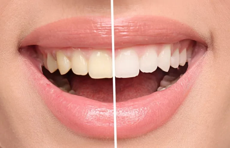 Example results from tooth whitening service, results may vary