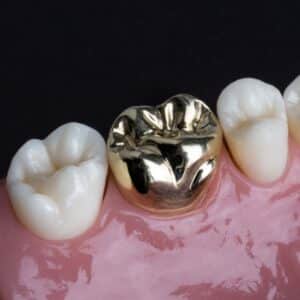 Gold crown on tooth